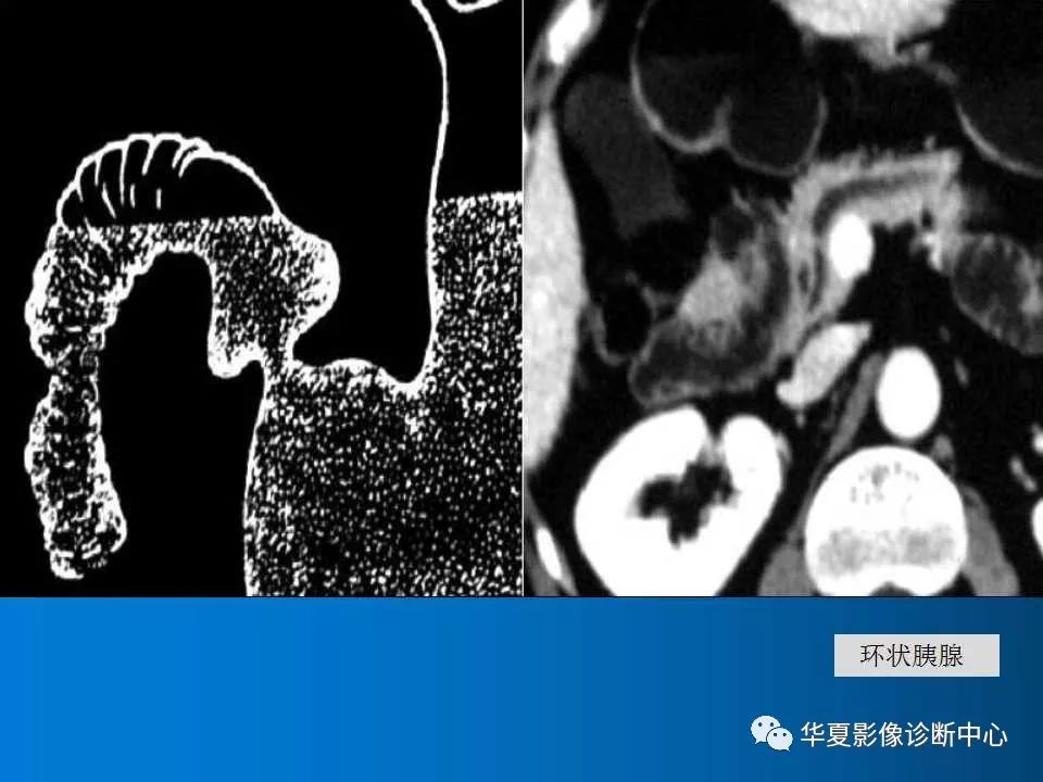 胰腺解剖及变异的影像表现