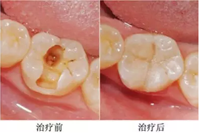 门牙上有个洞怎么办