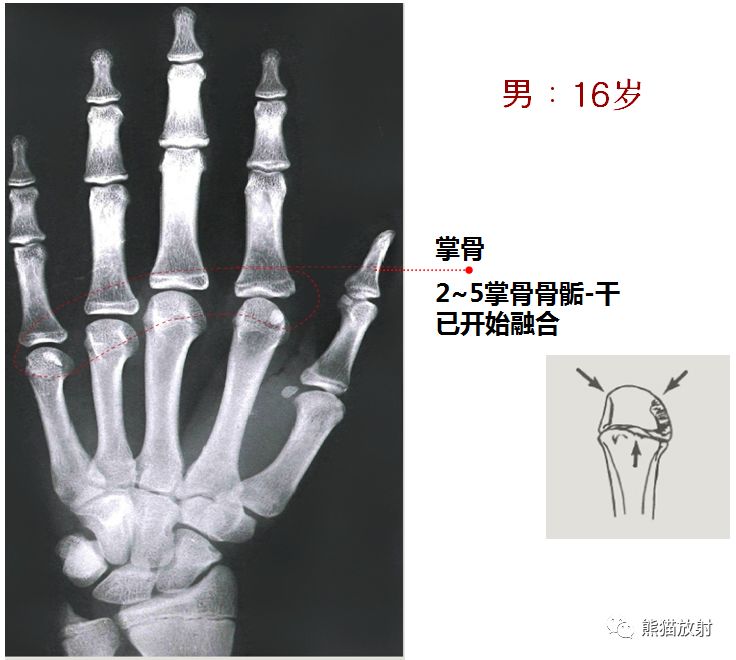 收藏丨骨龄图谱方便随时对照