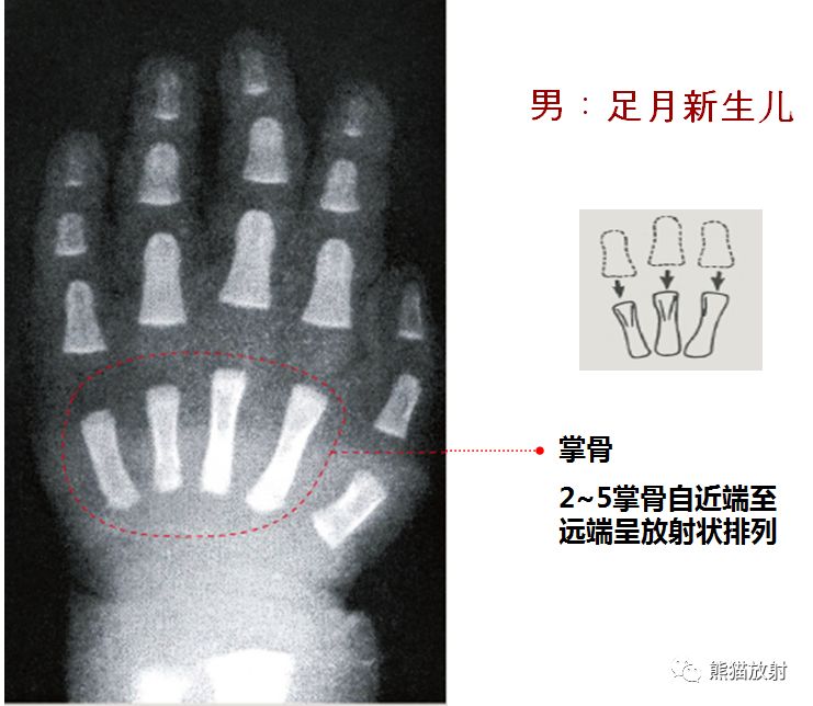 收藏丨骨龄图谱方便随时对照