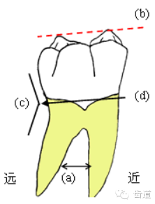 各个牙体雕刻之基本形态要求_远中