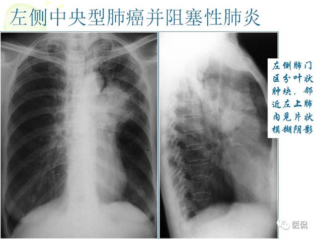 支气管肺癌怎么读片看看不同类型的支气管肺癌影像诊断