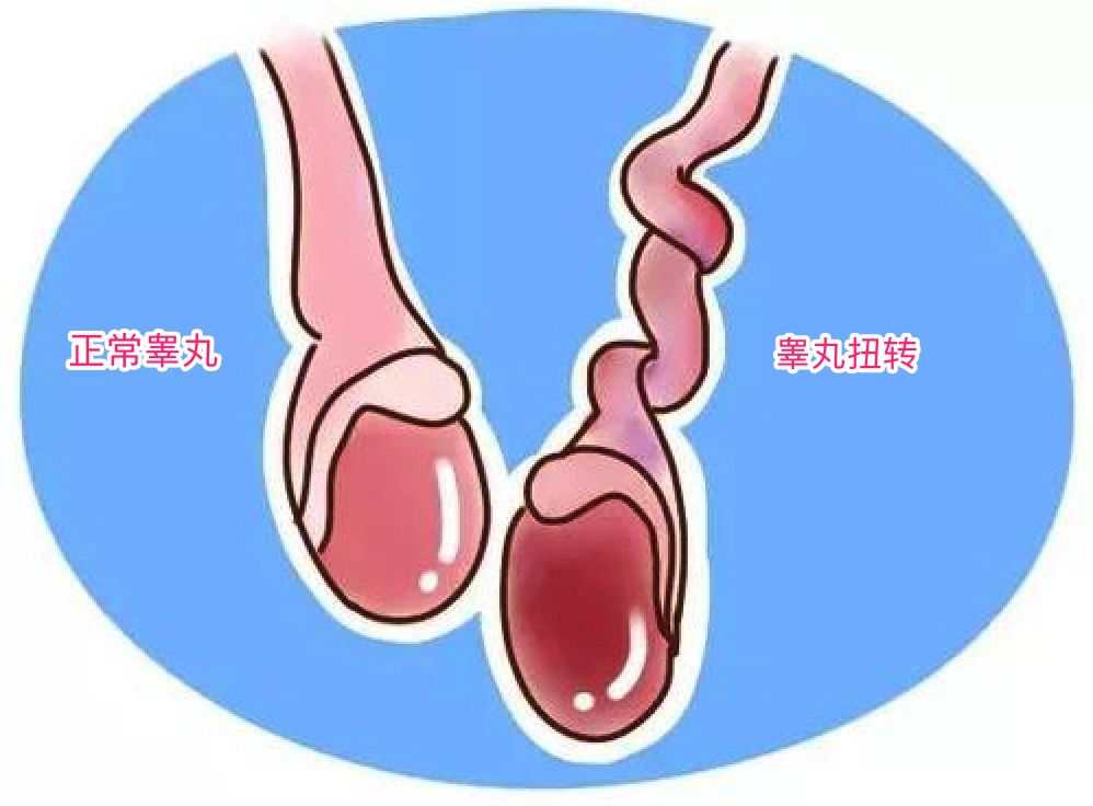 阳江市人民医院泌尿外二科连续收治了3例睾丸扭转患者,年龄在12