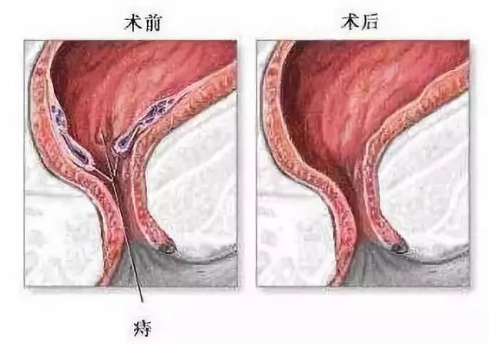 痔疮手术水肿怎么办