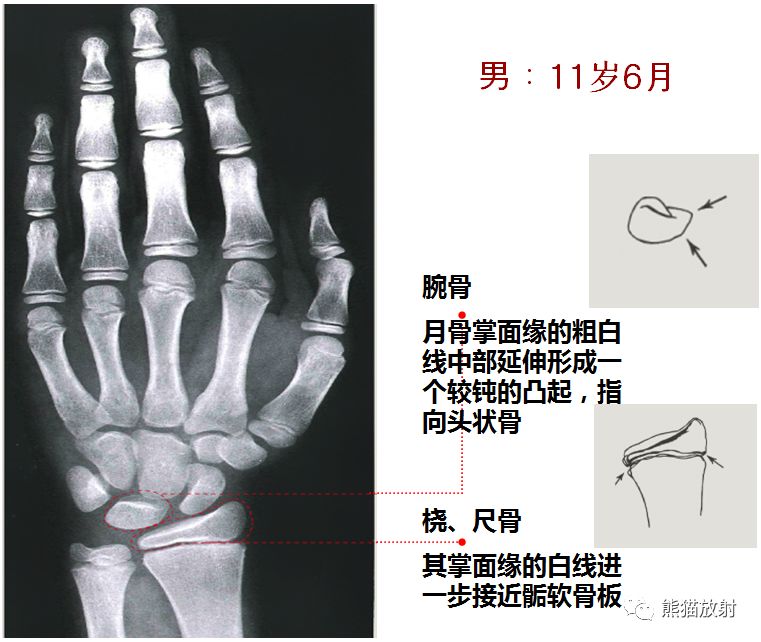 收藏丨骨龄图谱方便随时对照