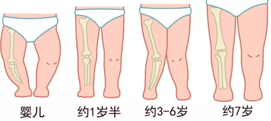 很多妈妈都会担心一个问题:宝宝都一两岁了,走路还是o型腿的姿势