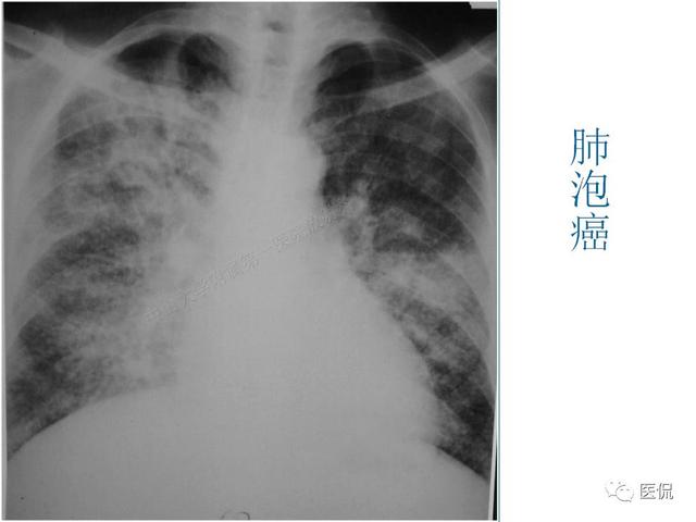 看看不同类型的支气管肺癌影像