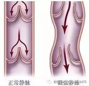 筋抻到了怎么办