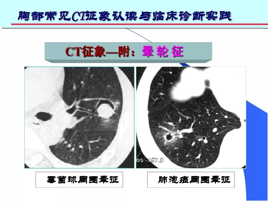 肺部高清ct