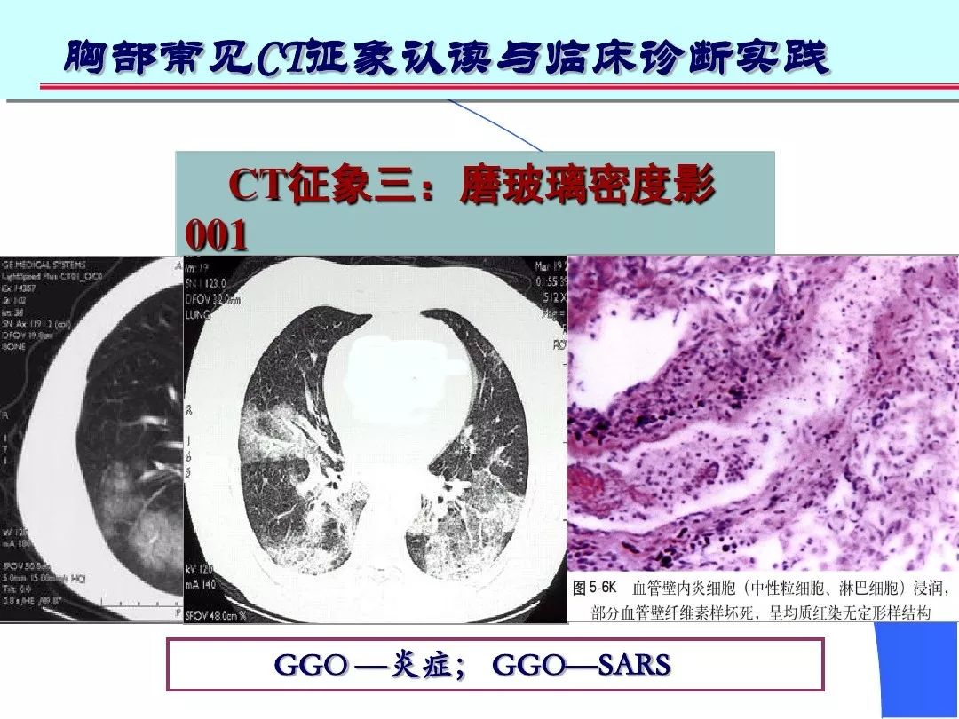 肺部高清ct