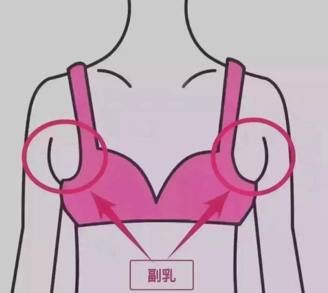 副乳是什么引起的?怎么去除? (原创)