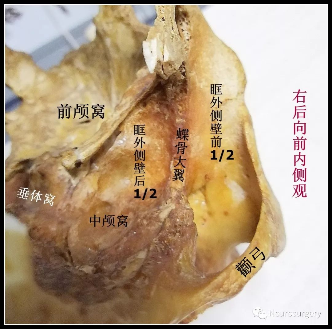 眶外侧壁的外侧面构成颞窝,颅中窝的一部分,其分界为蝶骨大翼(该分