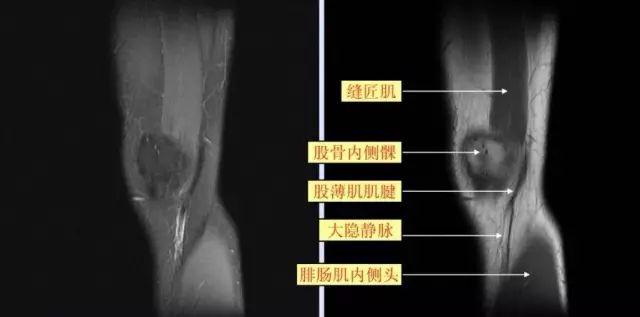 高清医学影像图:来看看最全面的膝关节mri解剖图谱,很