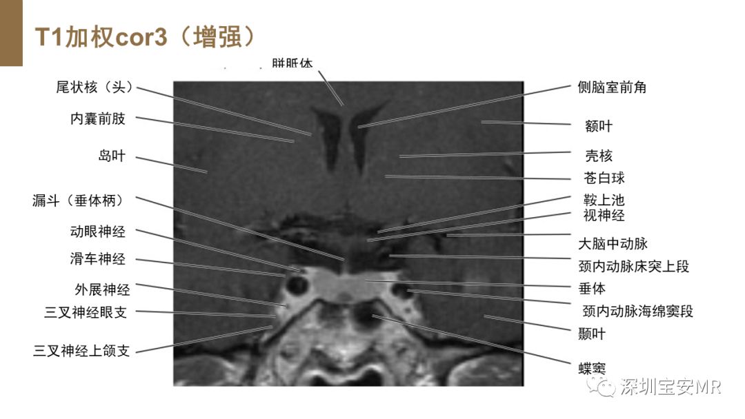 垂体磁共振影像解剖