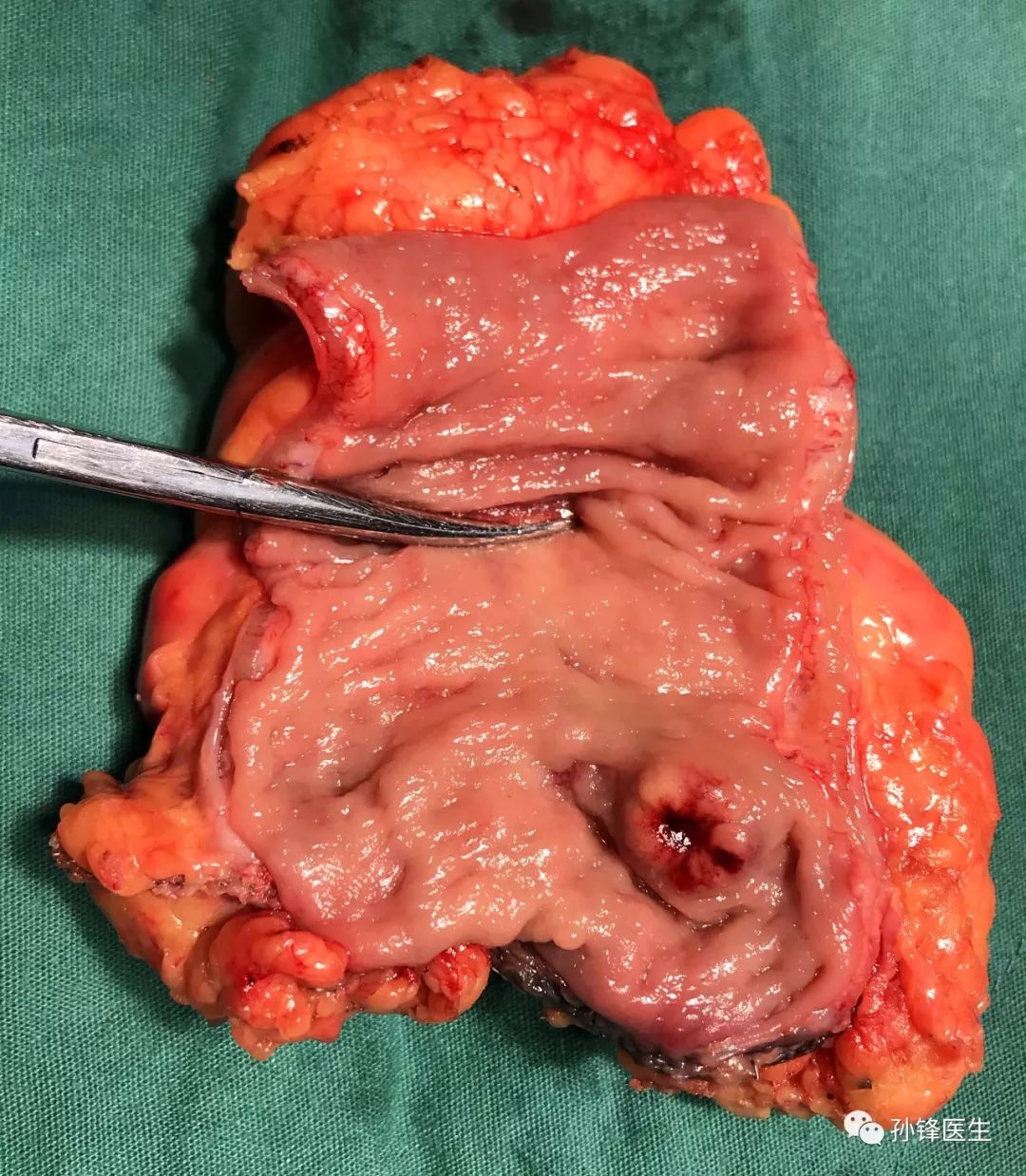 医学课堂直肠类癌rectalcarcinoid是癌吗