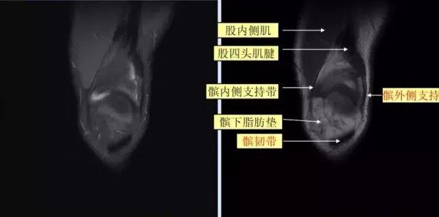 高清医学影像图来看看最全面的膝关节mri解剖图谱很详细