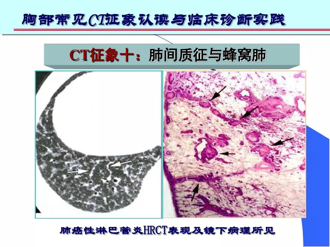 肺部高清ct