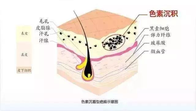 疤痕色素沉着怎么办