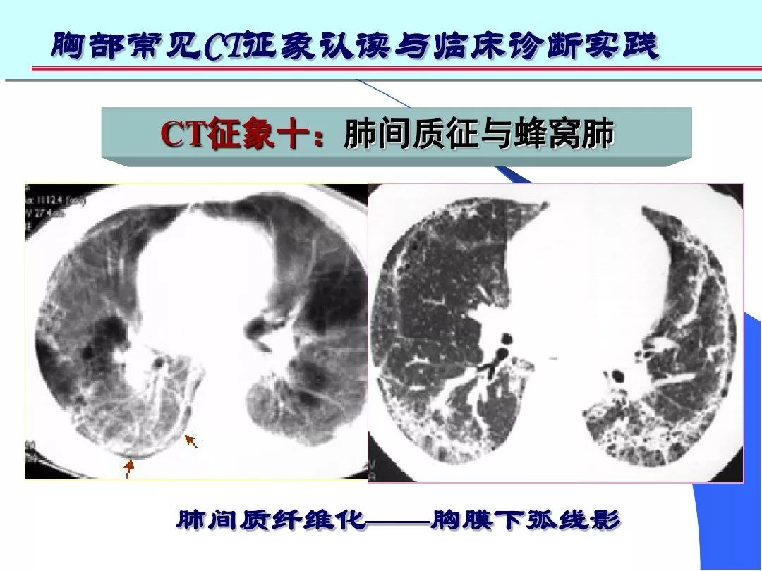 肺间质纤维化晚期——两肺蜂窝影