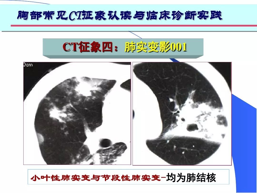 肺部高清ct