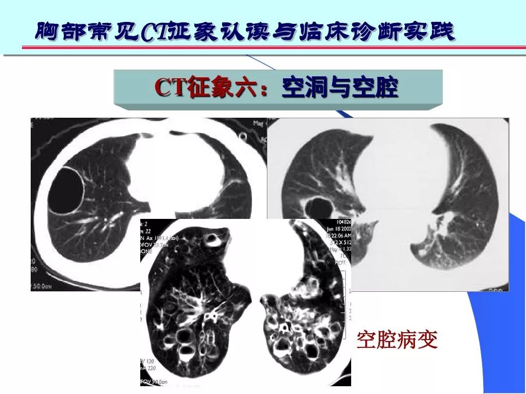 肺部高清ct