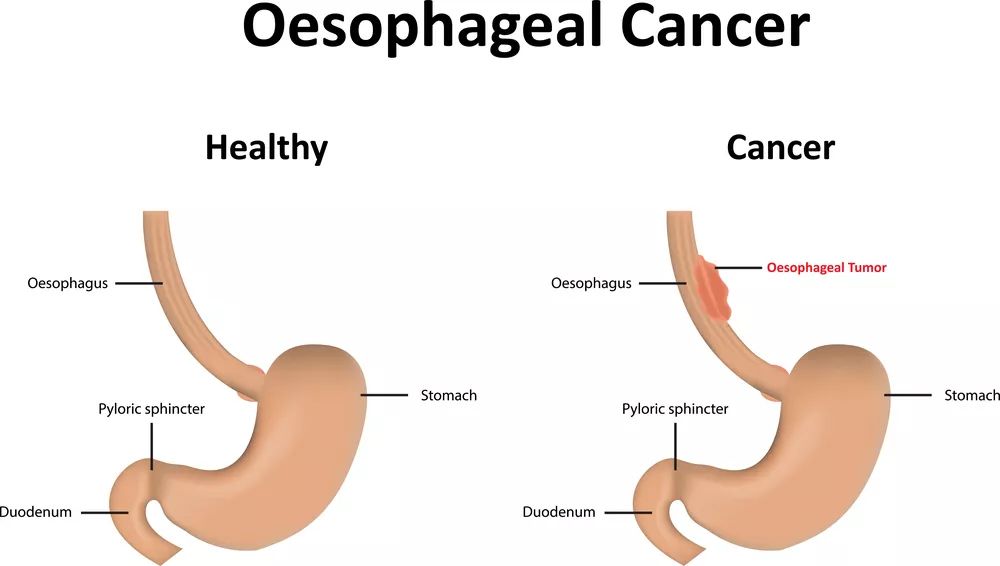 食管癌病人口水_食管癌晚期病人图片