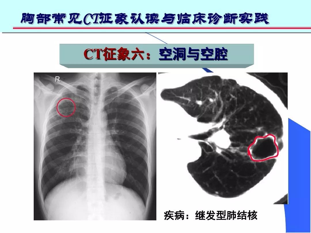 肺部高清ct