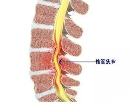 颈椎间孔狭窄怎么办