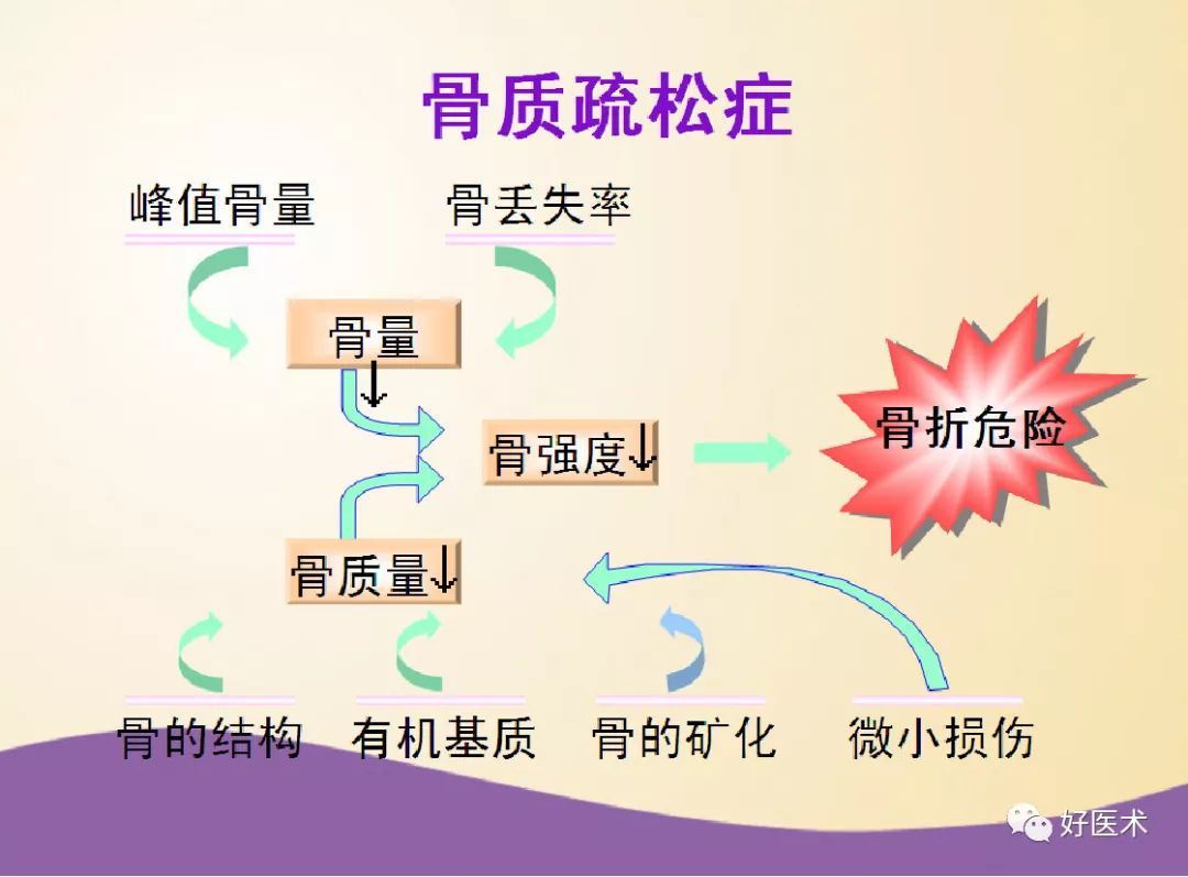 骨质疏松症5大要点详解