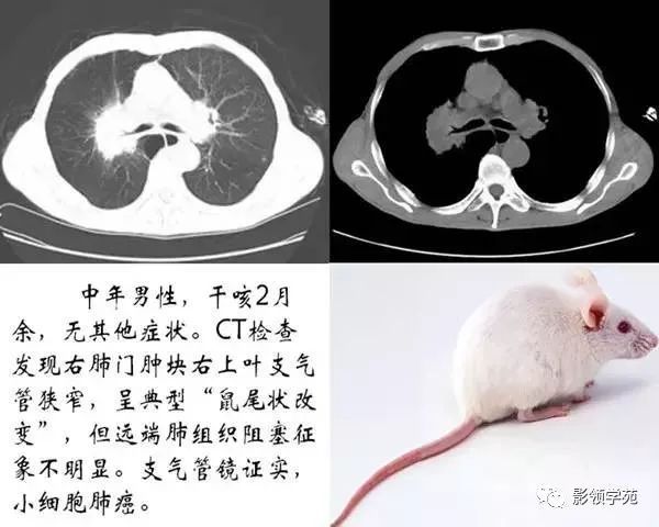 呼吸系统8种经典影像征解析