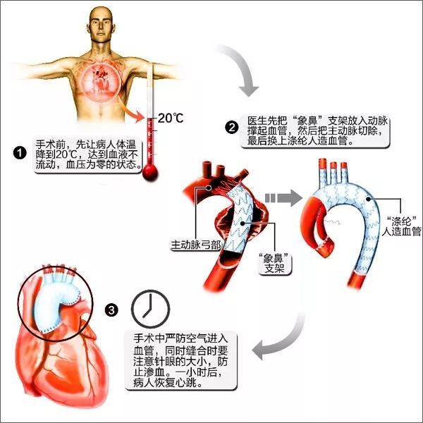 男子突发主动脉夹层命悬一线 医生妙手十小时"拆弹"成功