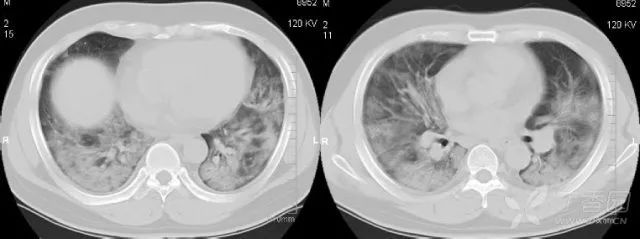 一文掌握 6 种胸部 ct 常见征象
