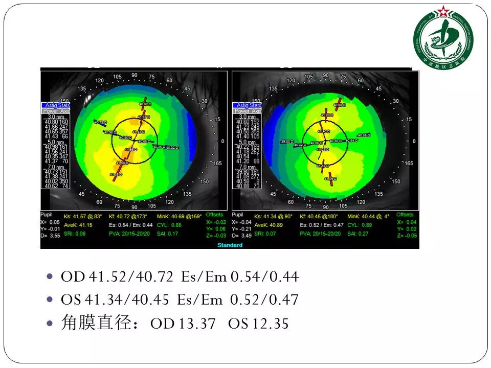 72,左眼40.45,水平方向e值0.44,0.47,他的角膜直径13.37mm,12.35mm.