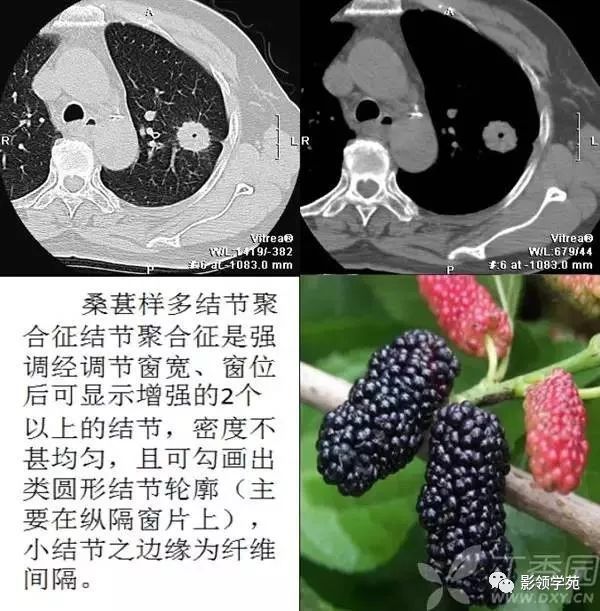 呼吸系统8种经典影像征解析