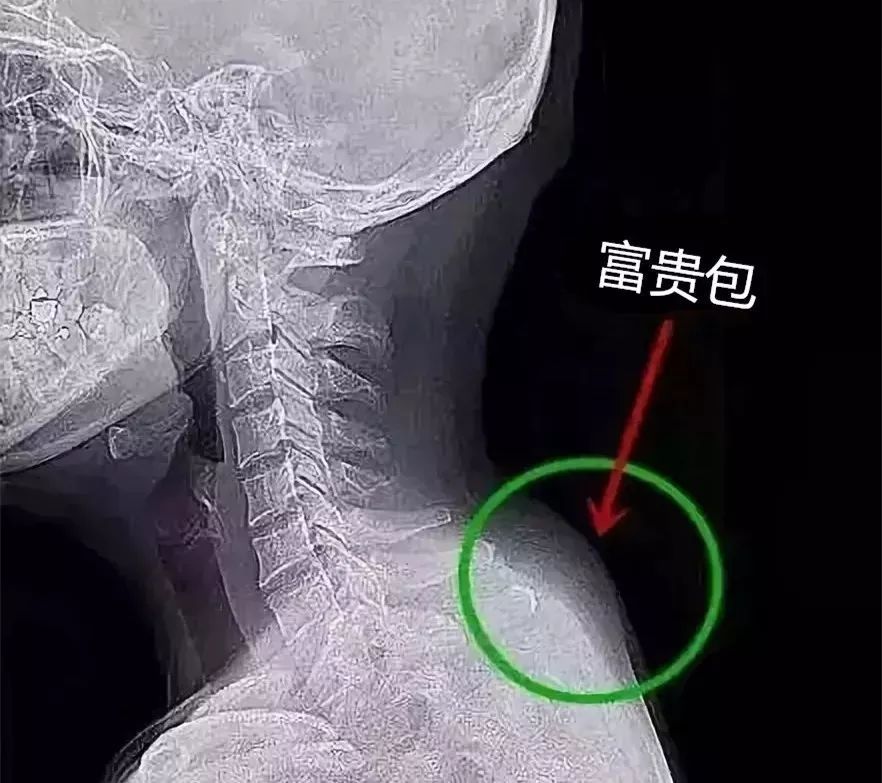 针刀治疗中心系列报道之二——富贵包与颈椎病