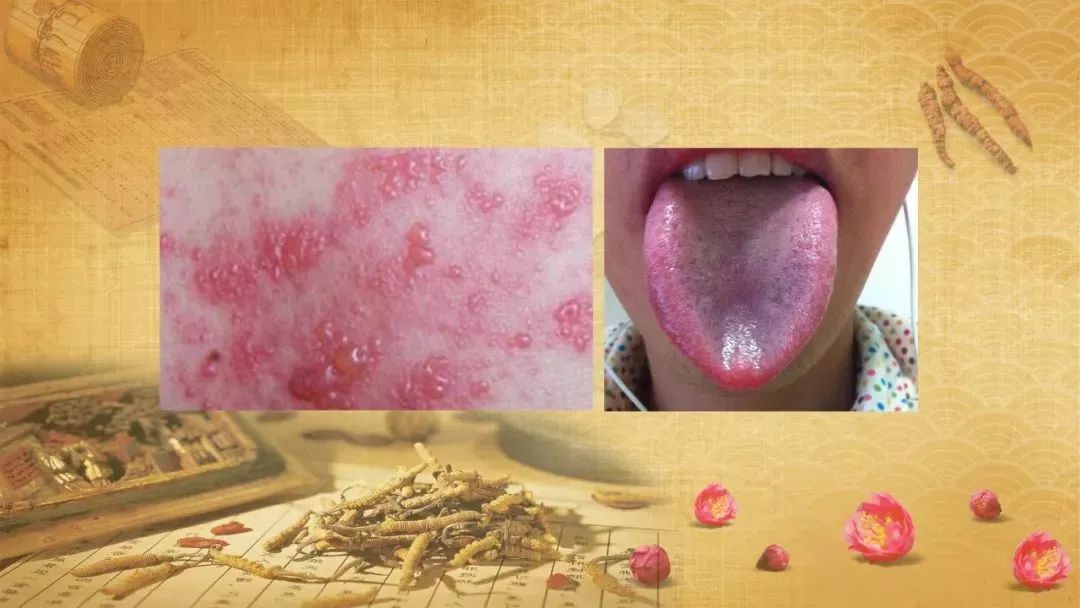 一个吹风机就能治好带状疱疹?是流言还是妙招?