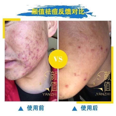 痤疮医院排名_医院常用治痤疮的药膏(2)