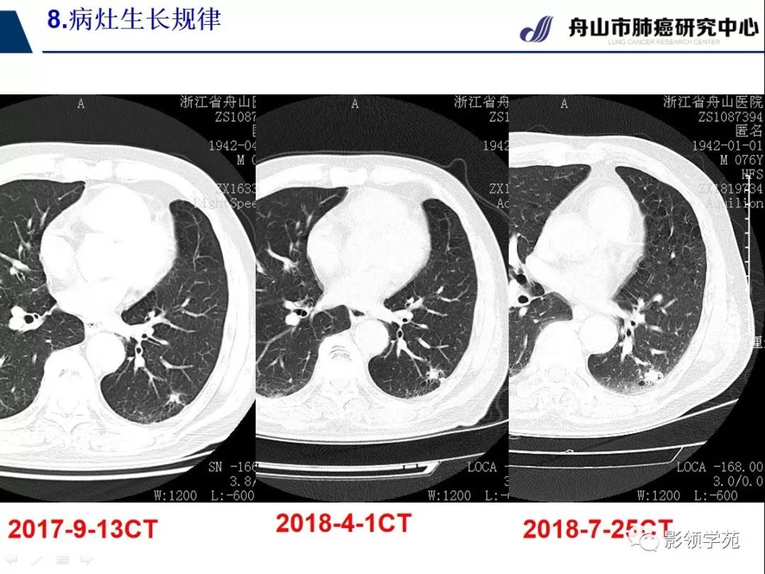 肺部硬结灶