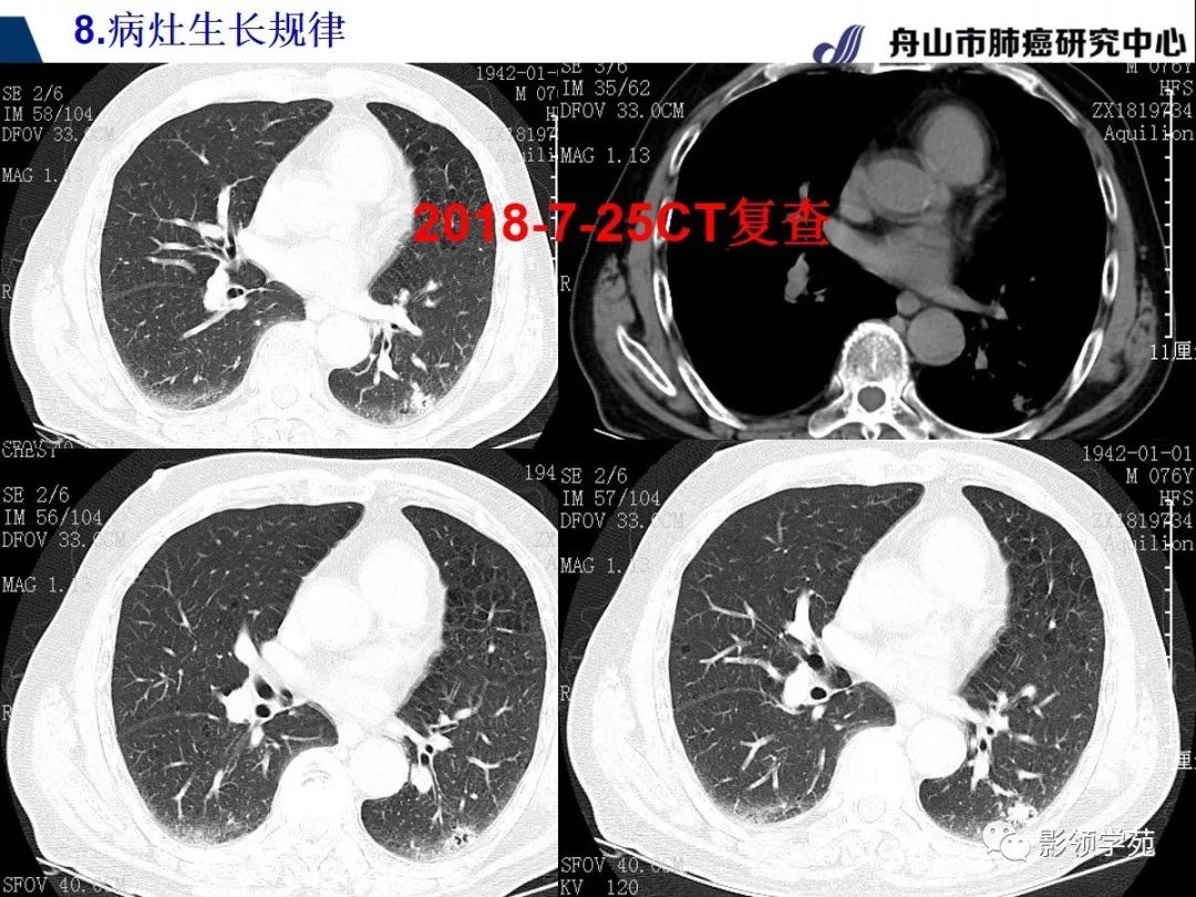 肺部硬结灶