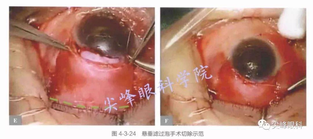 小梁切除术的术后常见问题并发症及其处理的问题解答part7图解青光眼