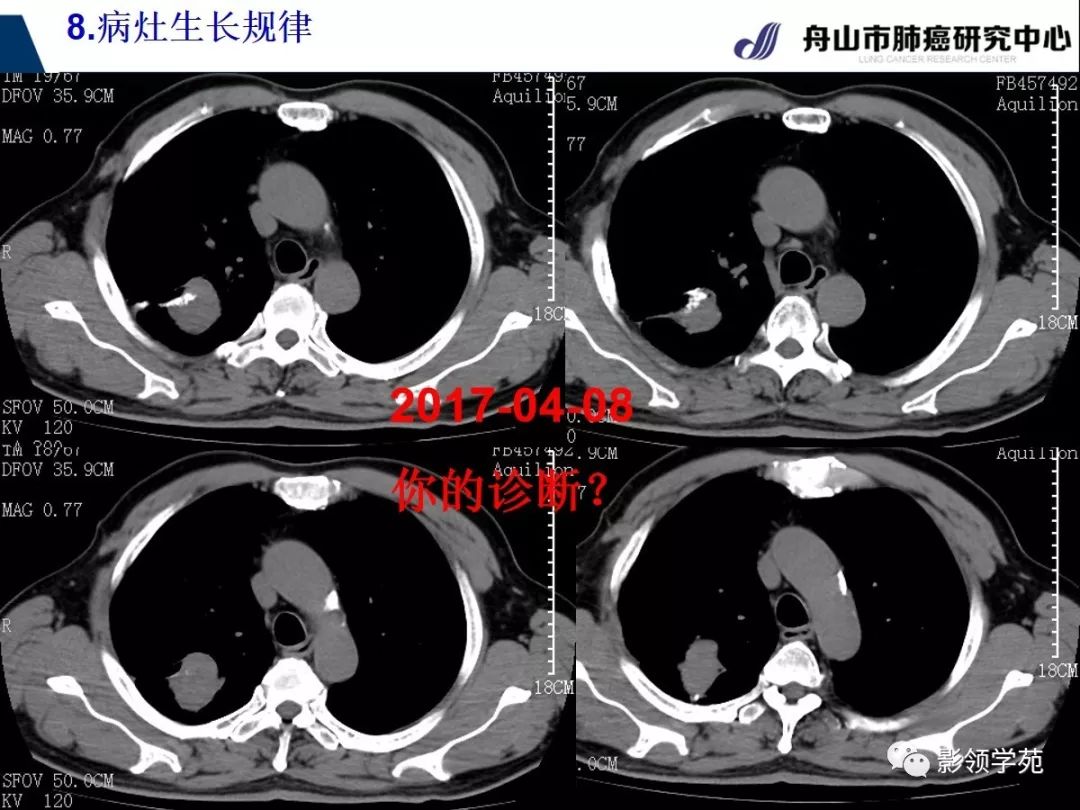 肺部硬结灶