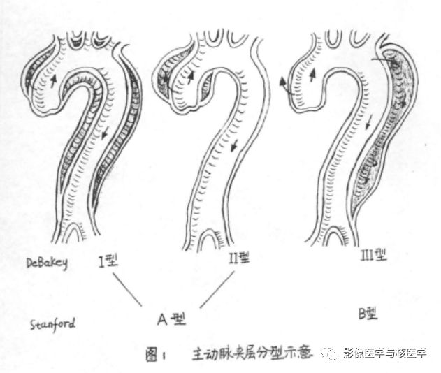 循环系统主动脉夹层分型