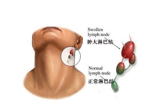 淋巴瘤