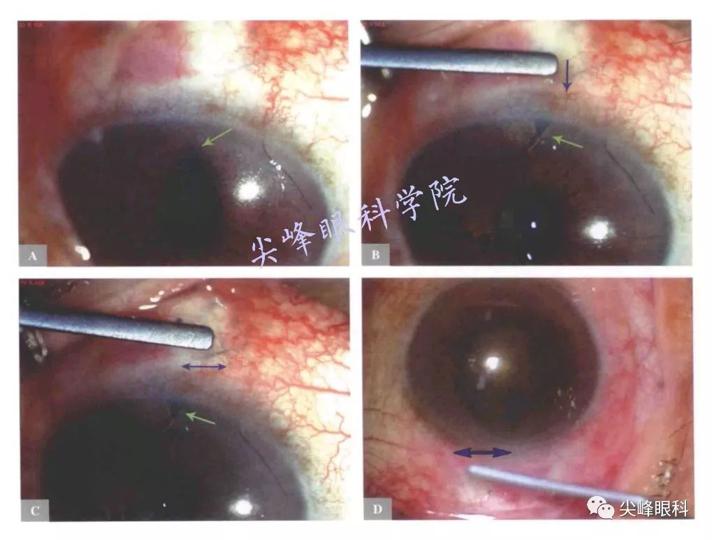小梁切除术的术后常见问题并发症及其处理的问题解答part8图解青光眼