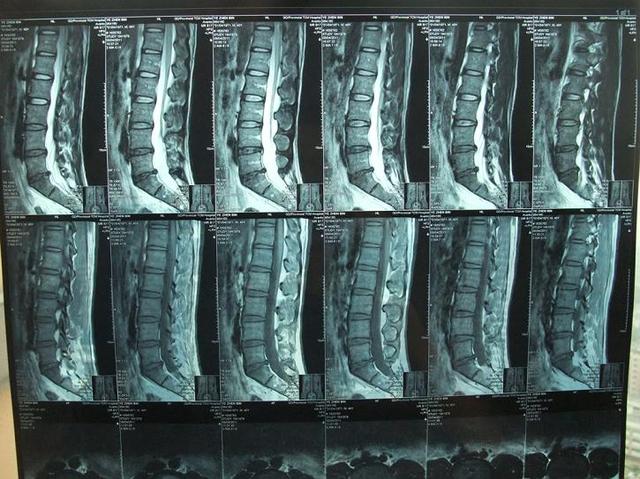 腰椎ct可以看到椎体内部的结构和是否有椎间盘突出或膨出,是否压迫