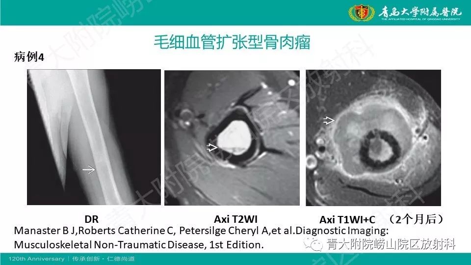 毛细血管扩张型骨肉瘤(telangiectatic osteosarcoma)