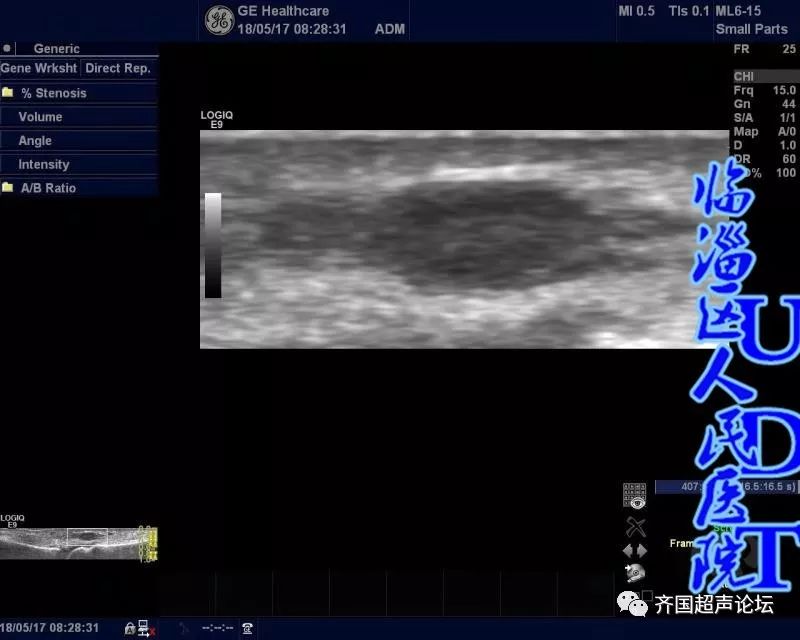 我院日常学习课程: 看完后有20个病例,有空的可以看看: 血管球瘤  中