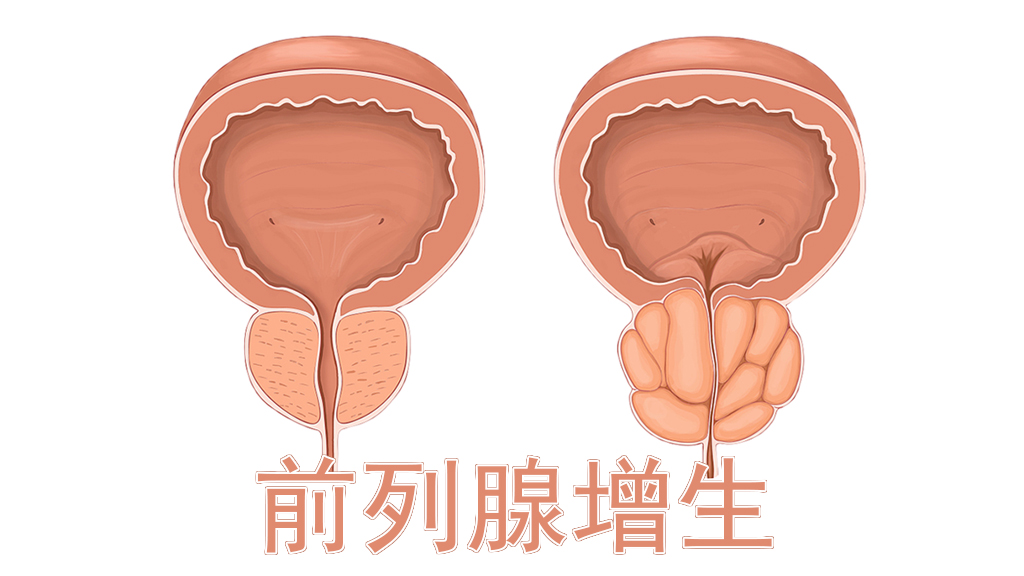 前列腺增生的症状