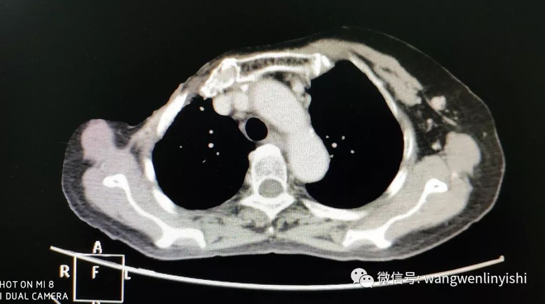 matrix-rib胸壁重建:乳腺癌放疗术后胸壁溃烂20年