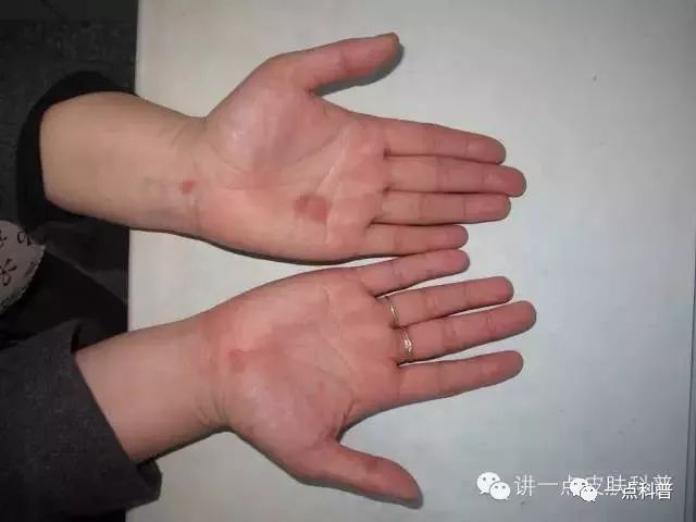 红斑, 手掌和脚掌是典型的铜红色的斑疹,不用说,二期梅毒疹基本可以